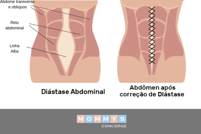 Diastase abdominal